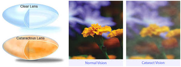 Clarity Eye Clinic - Cataract treatment at affordable prices