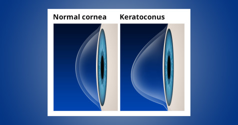 Keratoconus symptoms