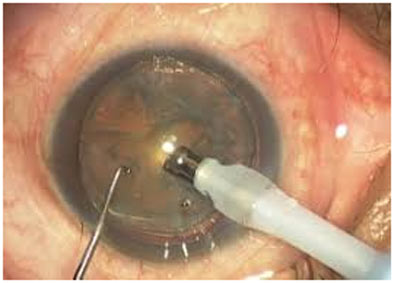 Clarity Eye Clinic - Femtosecond Laser Assisted Cataract Surgery